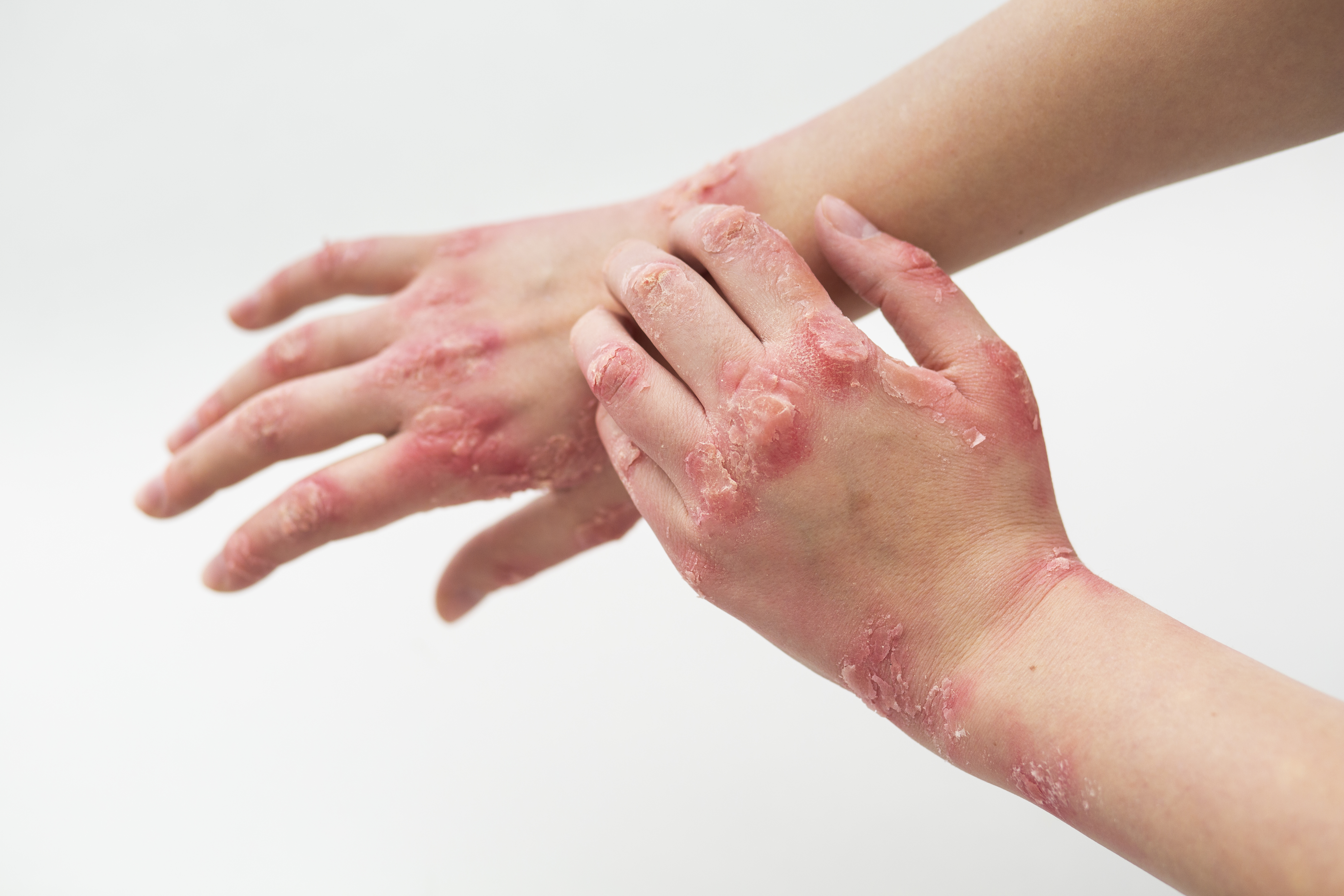 hands-patient-suffering-from-psoriasis