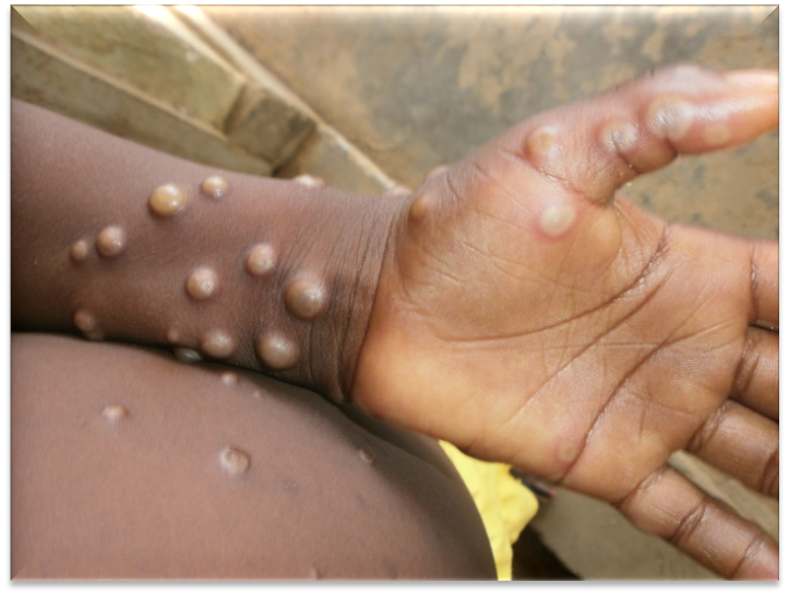 Brasil registra 2º caso de cepa mais letal do Mpox; saiba as chances de surto no país