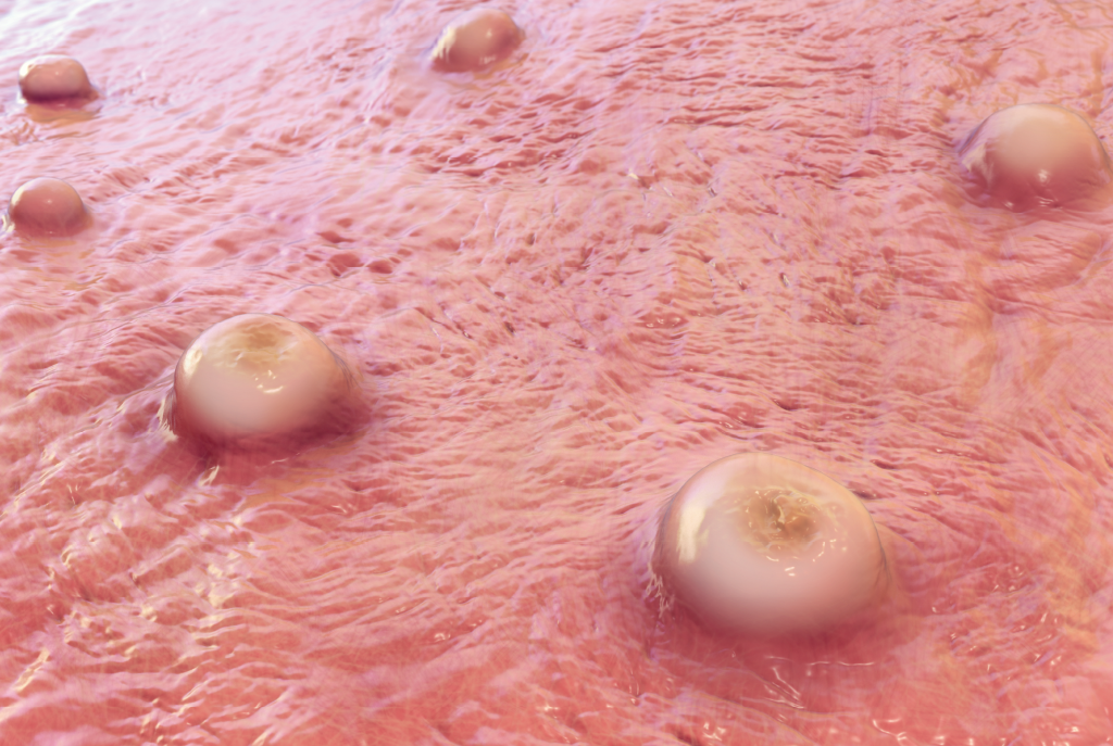 Mpox: veja em detalhes o que a doença viral pode fazer com a pele