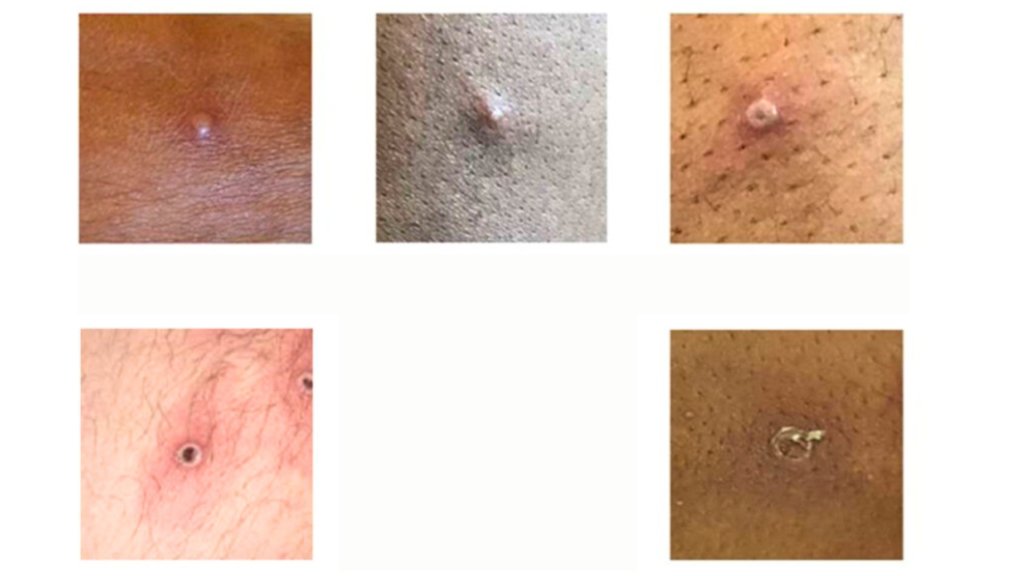 mpox real