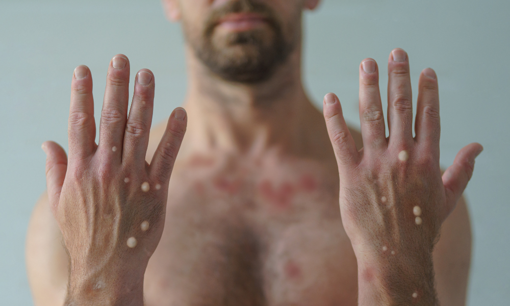 Imagem de homem mostrando mãos com bolhas características de mpox.