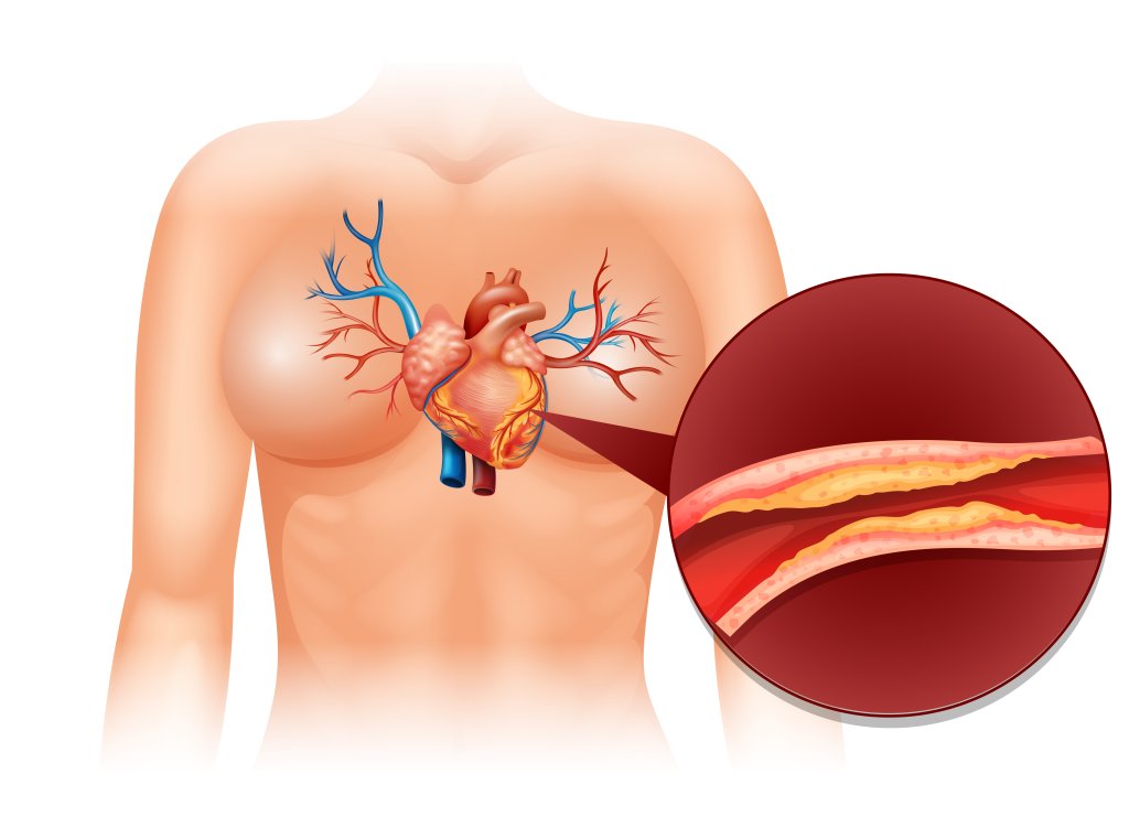 Aterosclerose: o que é, sintomas e tratamento