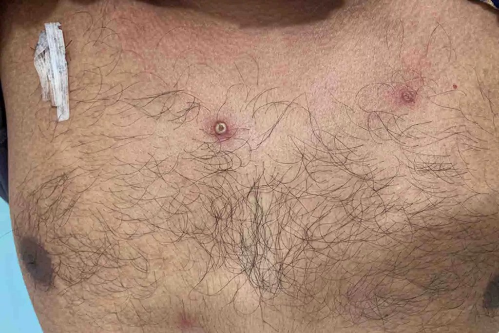 Mpox: é preciso usar máscaras? Como prevenir? Quais os sintomas? Tire dúvidas