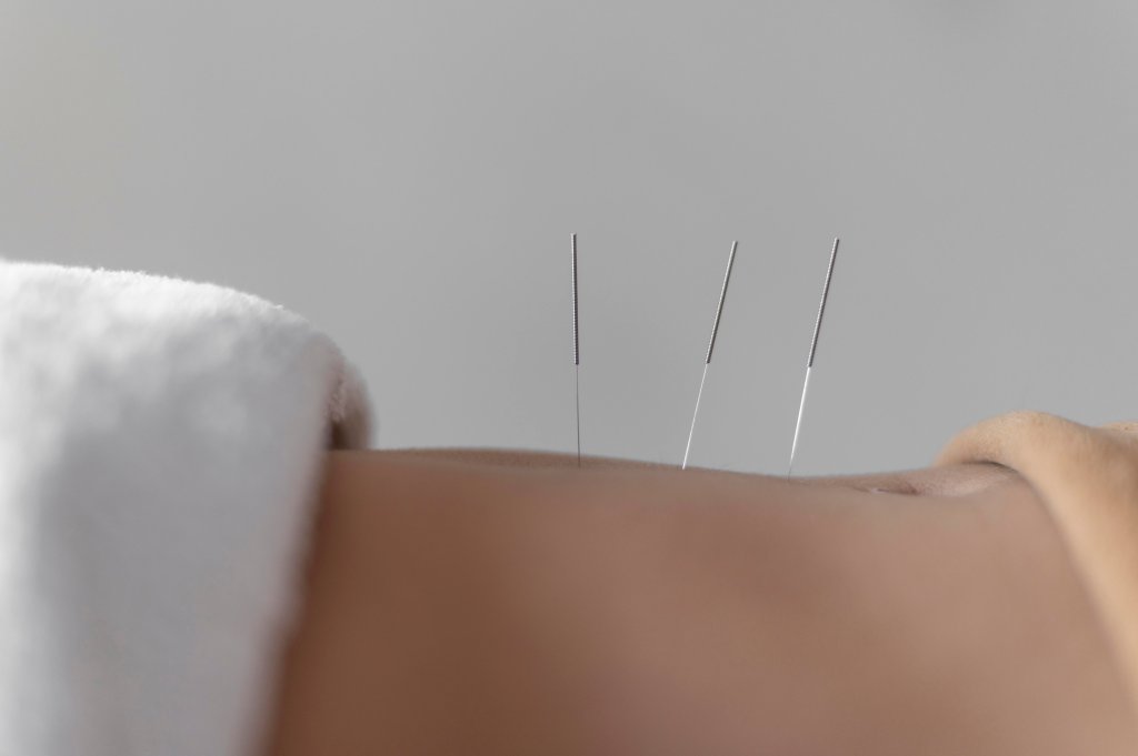 Acupuntura controla a fome? Entenda decisão que autoriza nutricionistas a aplicarem a técnica