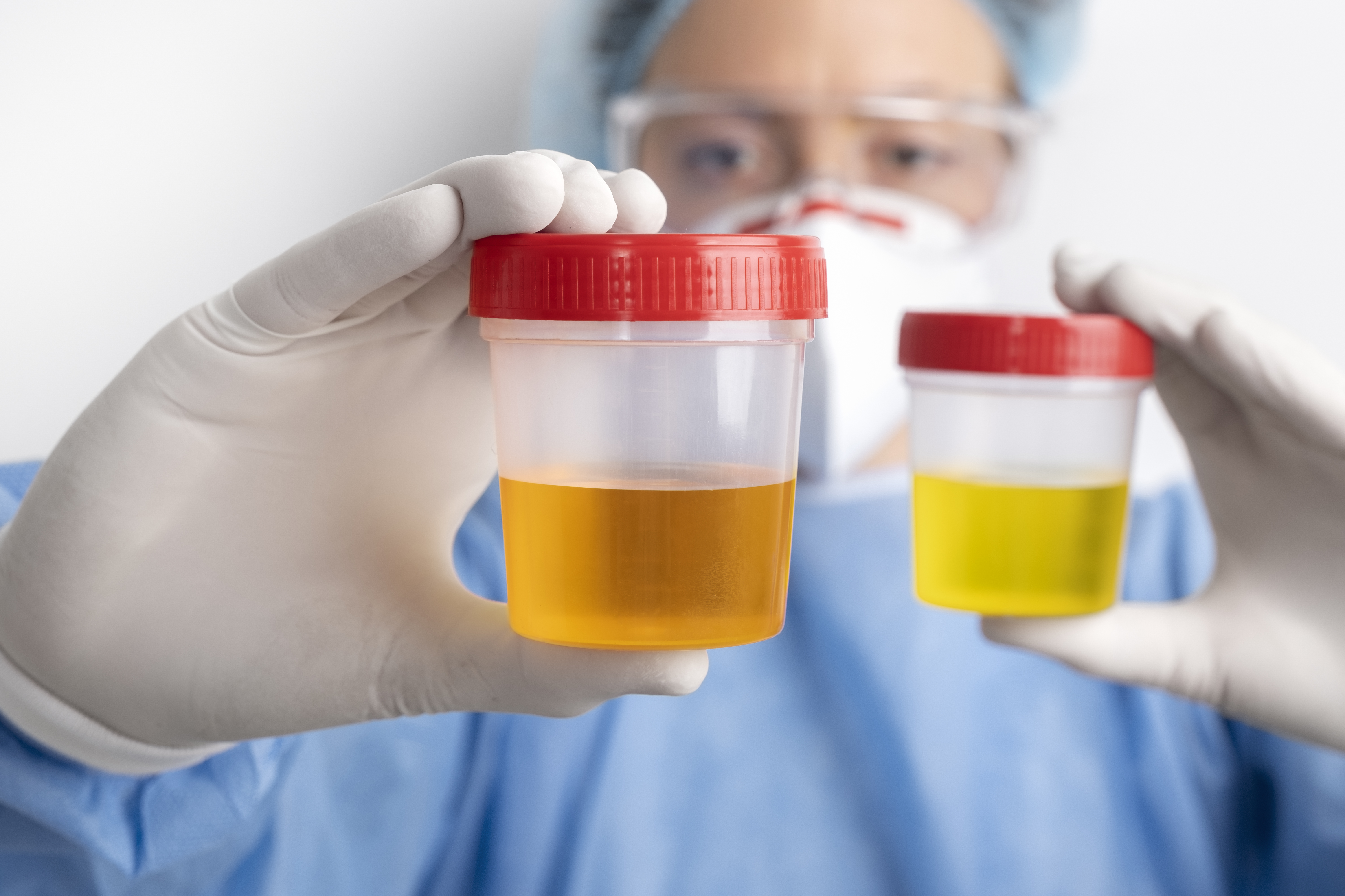 Proteína na urina: por que ela aparece e quando se preocupar