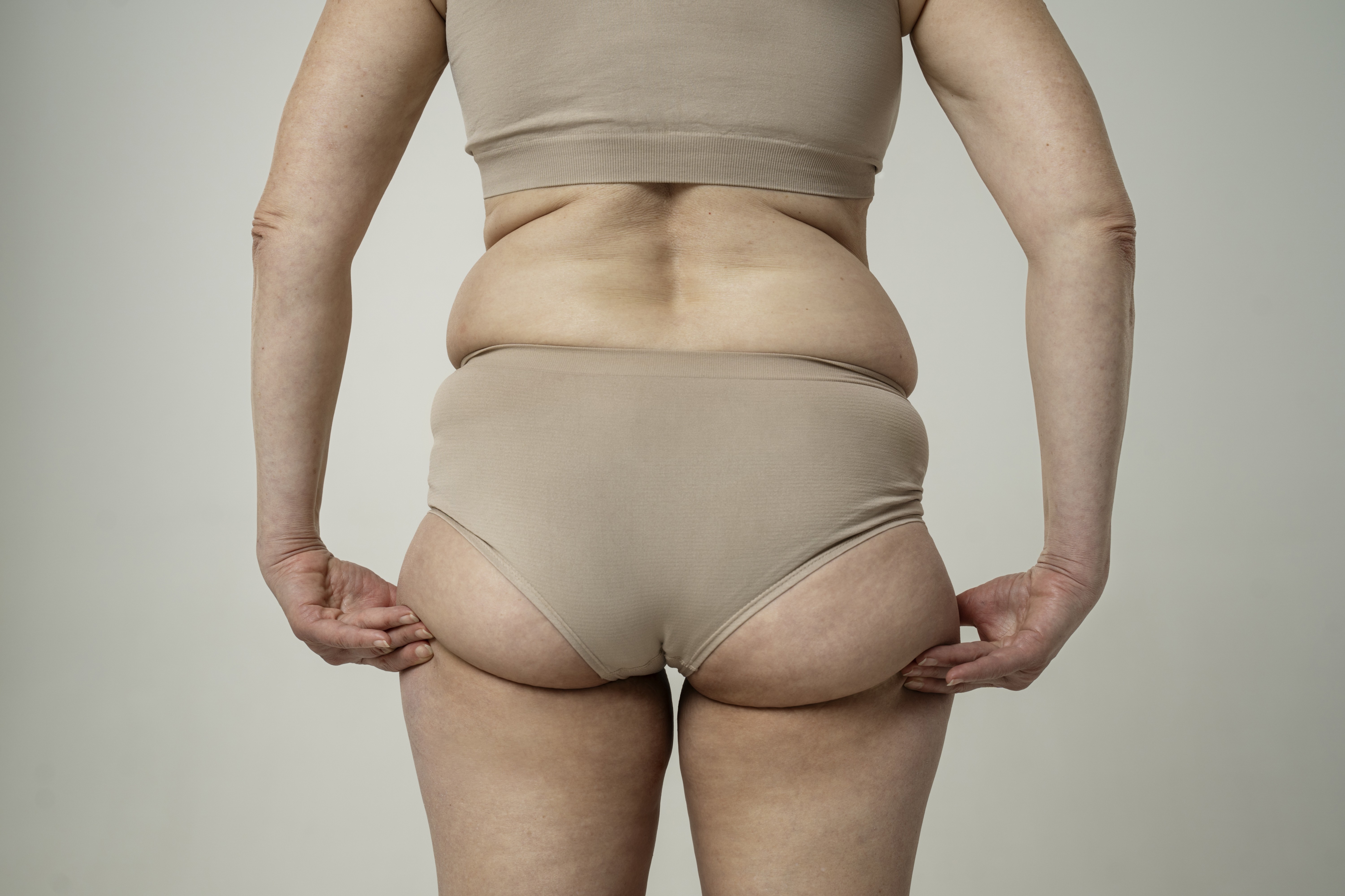 Como perder culote? Exercícios e alimentação ajudam, mas não fazem milagre