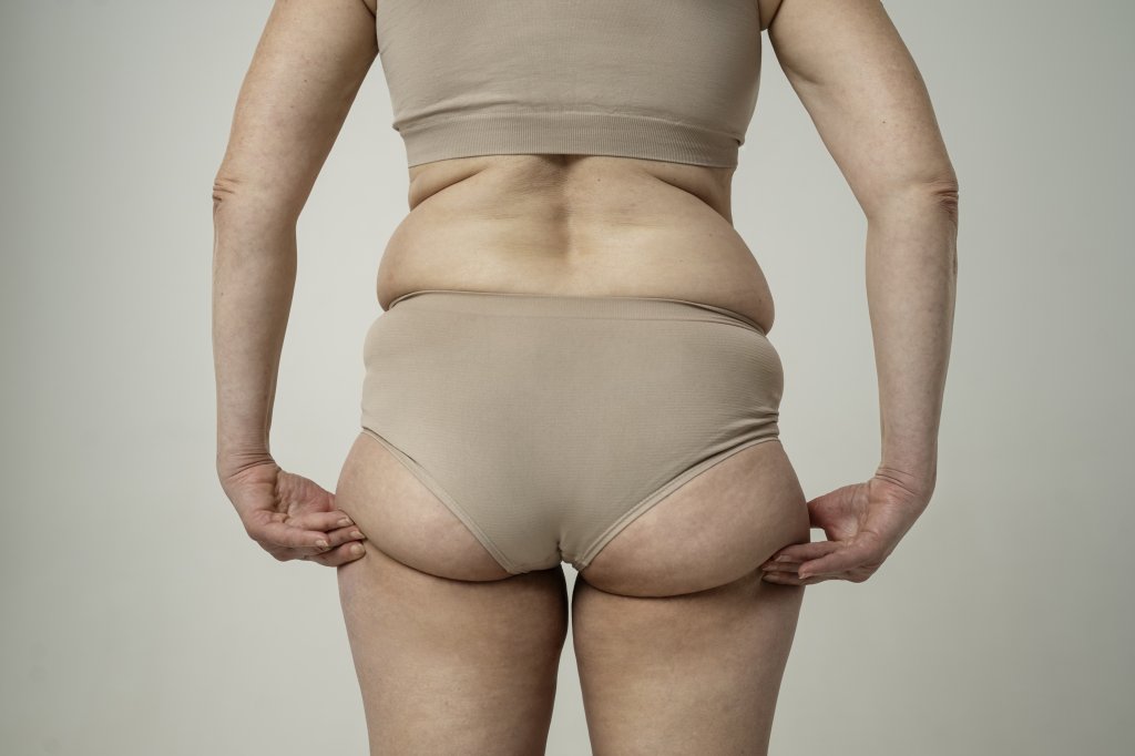 Como perder culote? Exercícios e alimentação ajudam, mas não fazem milagre