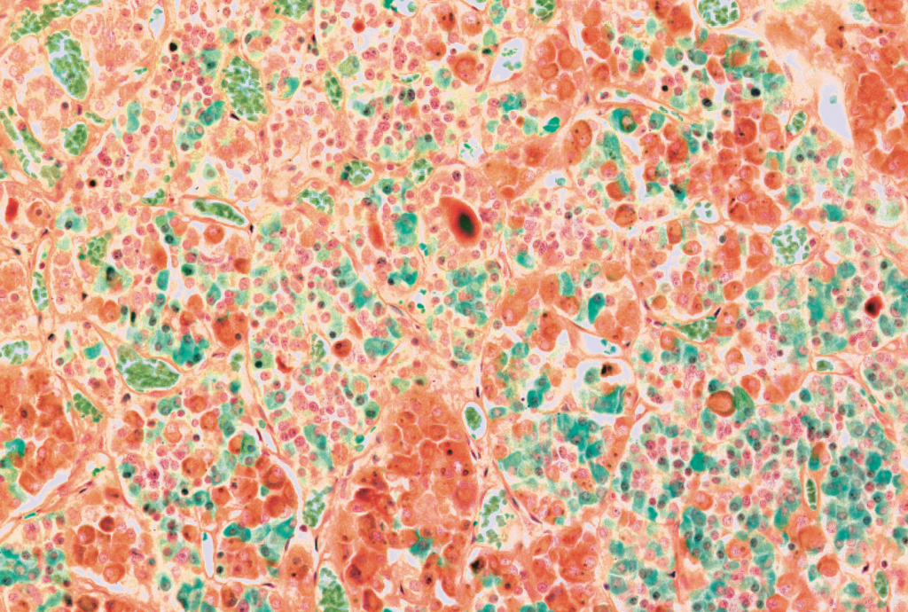 Microscopia de tecido com células em tons de laranja, verde-azulado e pontos pretos, formando uma textura granular e irregular