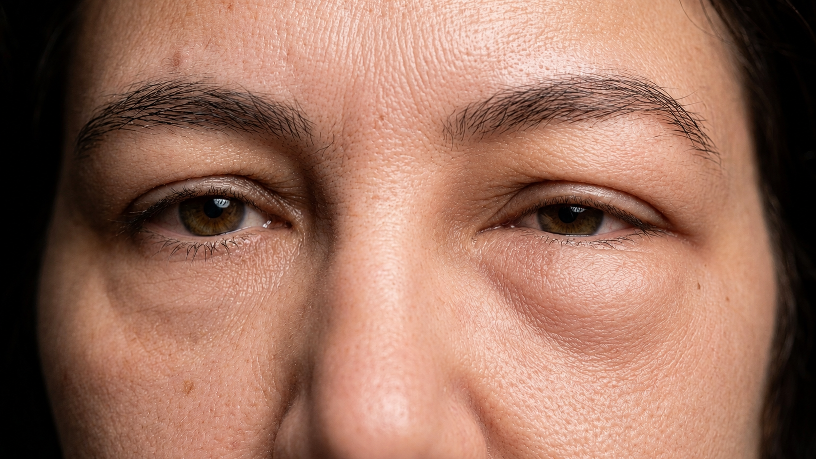 Close-up do rosto de uma pessoa com pele clara e olhos castanhos, apresentando olheiras e inchaço sob os olhos
