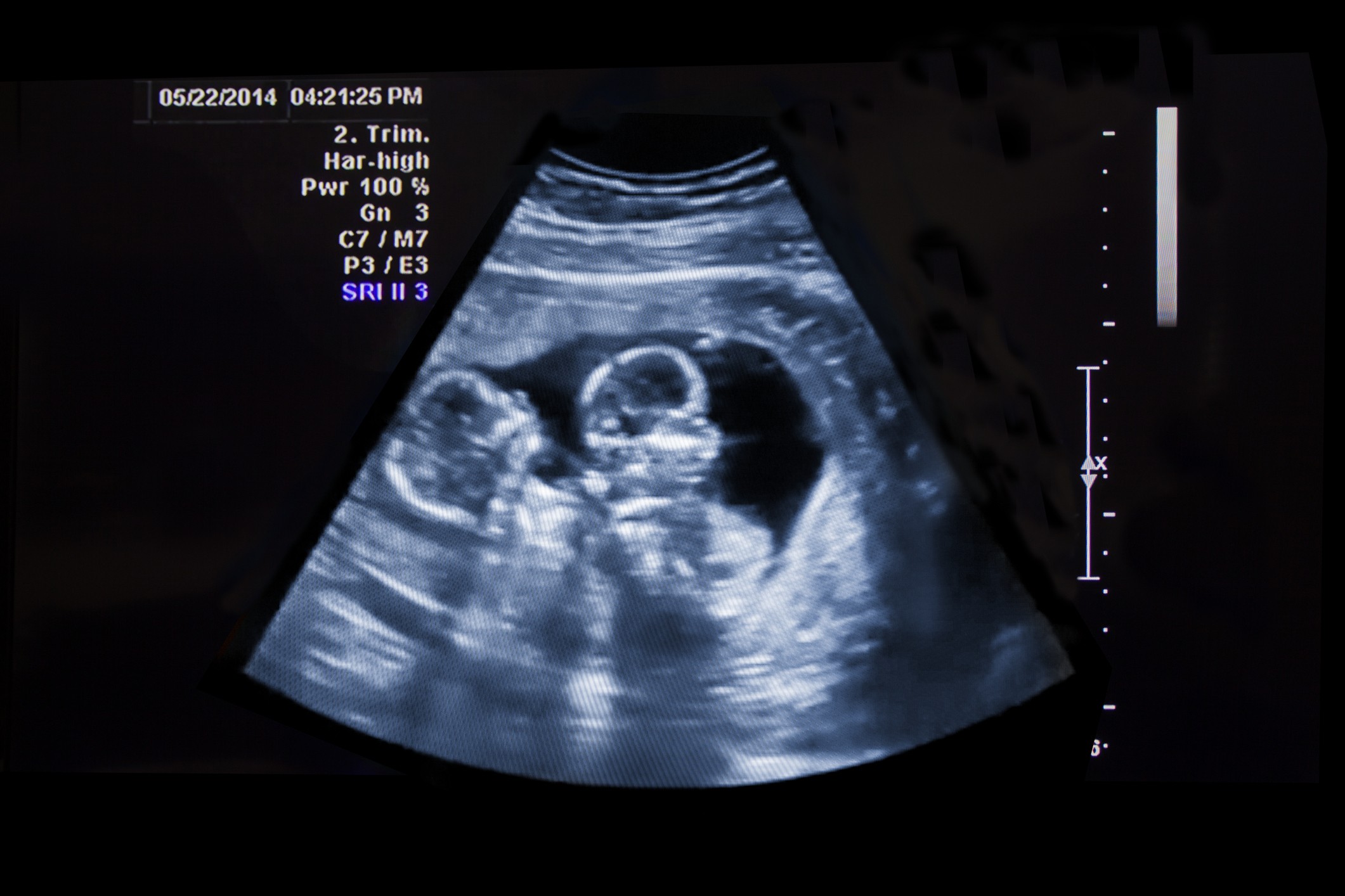 Ultrassom fetal em tons de azul e cinza, mostrando um bebê em posição fetal dentro do útero. No canto superior esquerdo, a data 05/22/2014 e hora 04:21:25 PM, com informações técnicas do exame como 2. Trim. e Pwr 100%